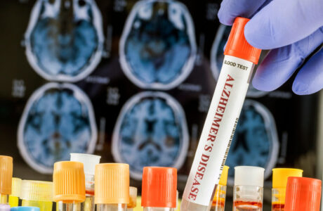 Organoidi cerebrali per la ricerca sull'Alzheimer